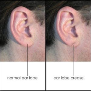 diagonal-earlobe-crease